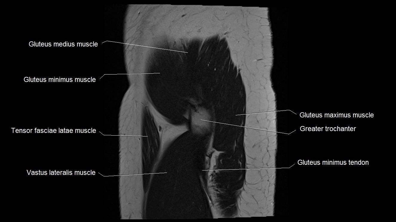 Hip sagittal cross sectional anatomy image 5.webp